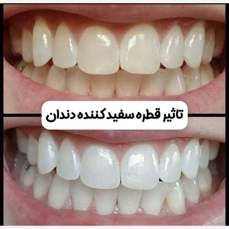 سرم سفید کننده دندان لانبنا