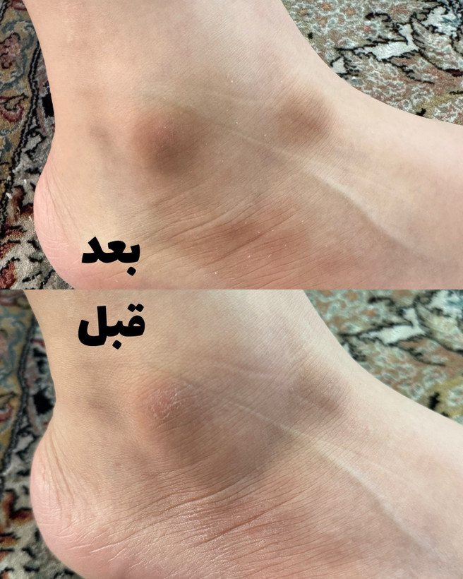 اسپری ترک و ضد خشکی پا راکو